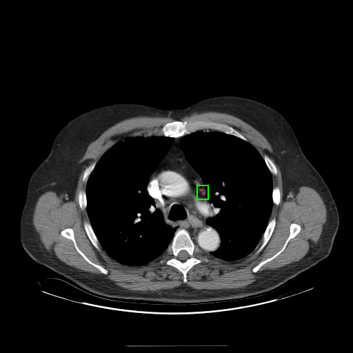 Lung Cancer Detection Using Yolo V Object Detection Dataset V