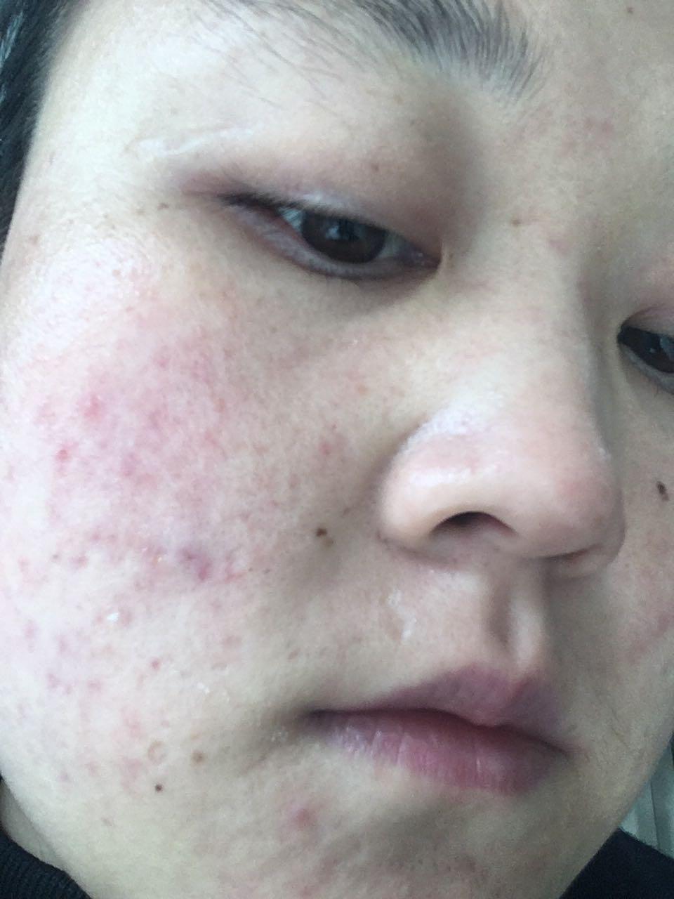 Acne Detection Folder 2 Object Detection Dataset by le duc minh Quan