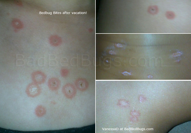 Insect Bite Mark Object Detection Dataset by Insect Bite Mark