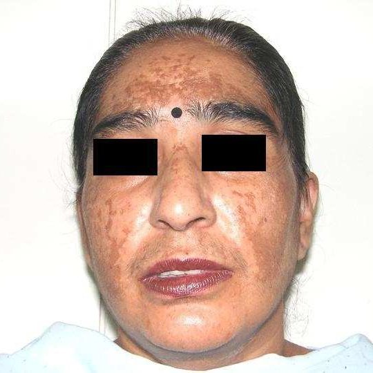 Melasma Detection Classification Dataset and PreTrained Model by task