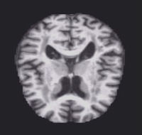 alzheimer2 Classification Dataset by tevfikagdas