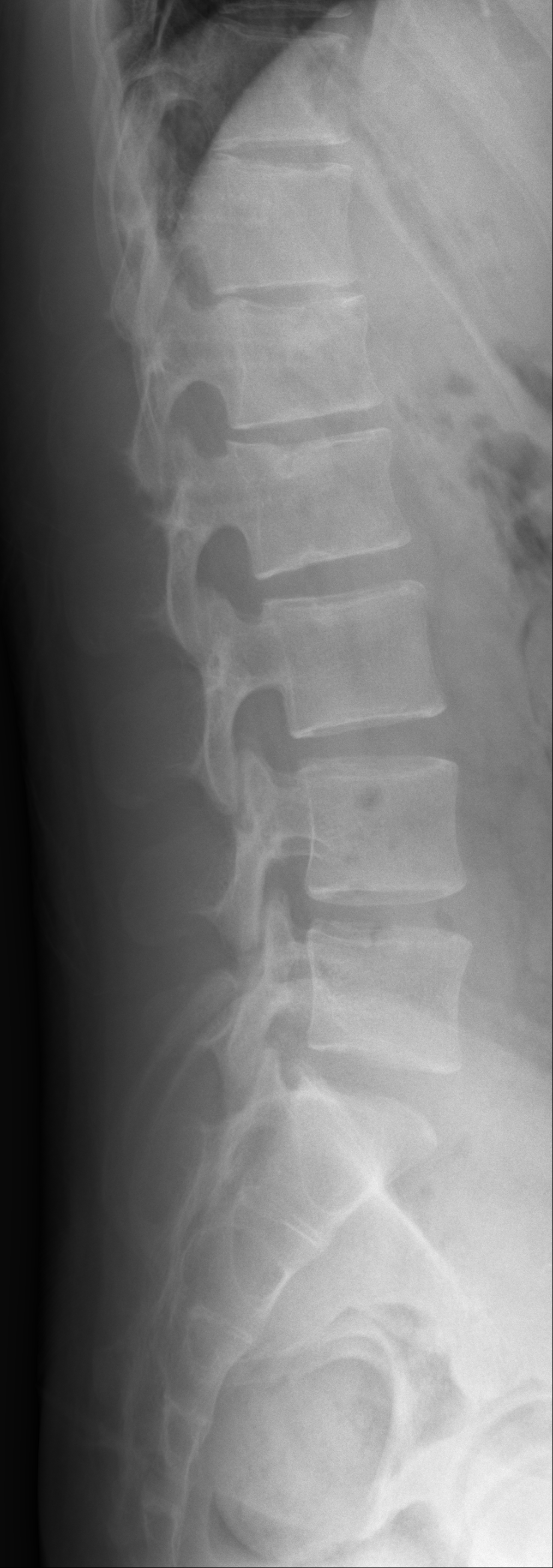 spine_fracture_100 Object Detection Dataset and Pre-Trained Model by ...