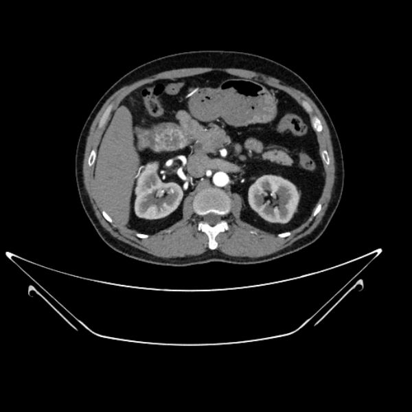 Top Kidney_stone Datasets and Models | Roboflow Universe