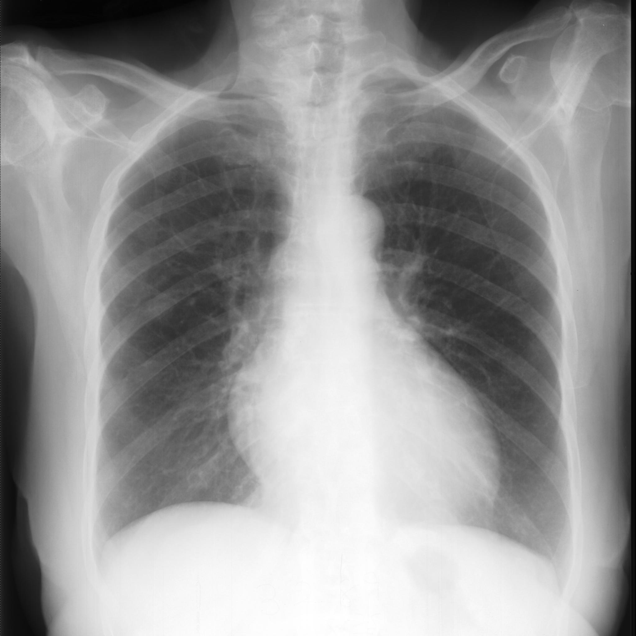 Chest Xray Classification Dataset by JECRC UniversityJaipur