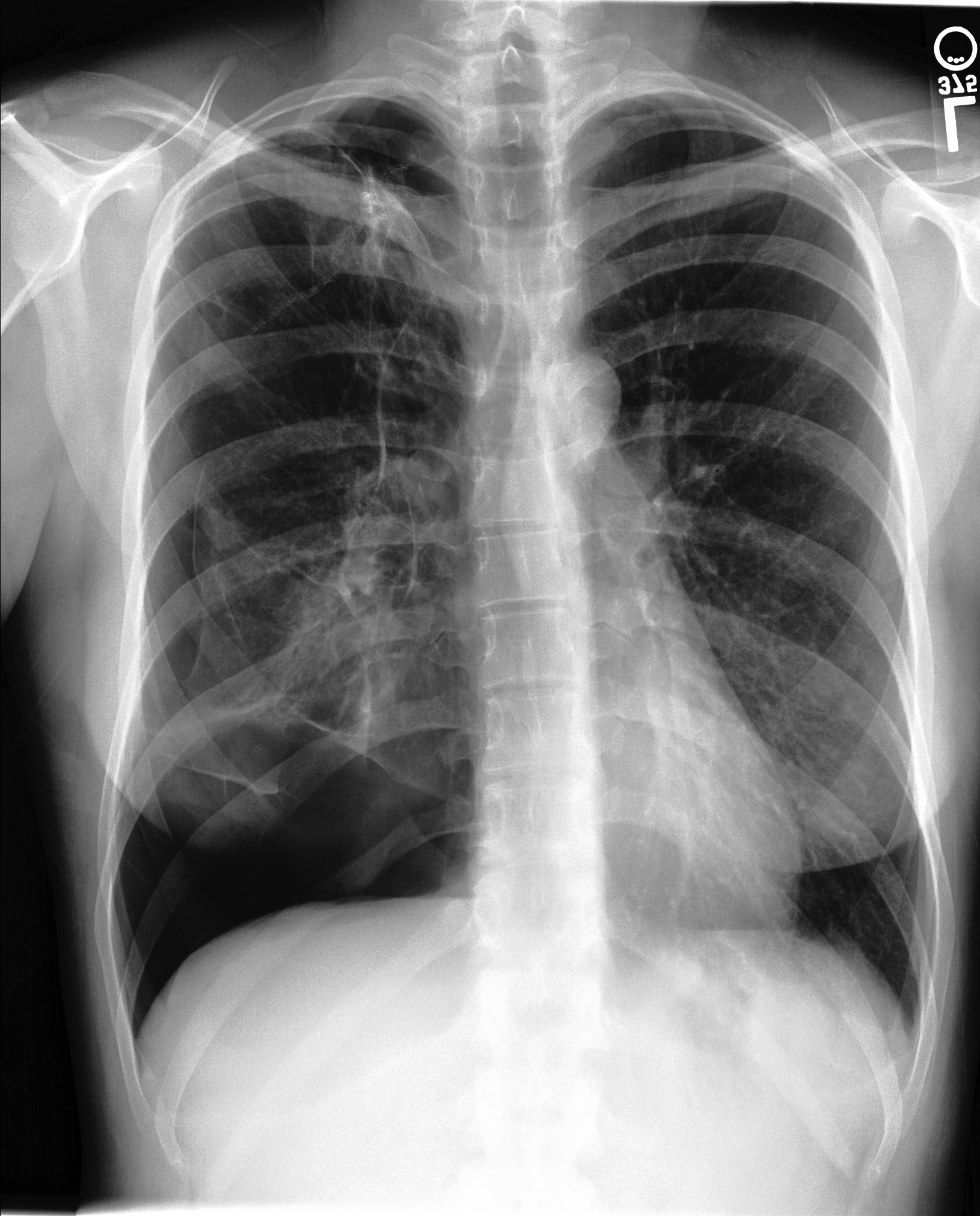 Vision Language CXR Object Detection Dataset and Pre-Trained Model by MSCXR