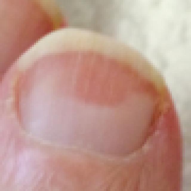 Nail Disease Detection Object Detection Dataset and PreTrained Model