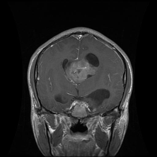 Brain Tumor Classification Classification Dataset And Pre Trained Model