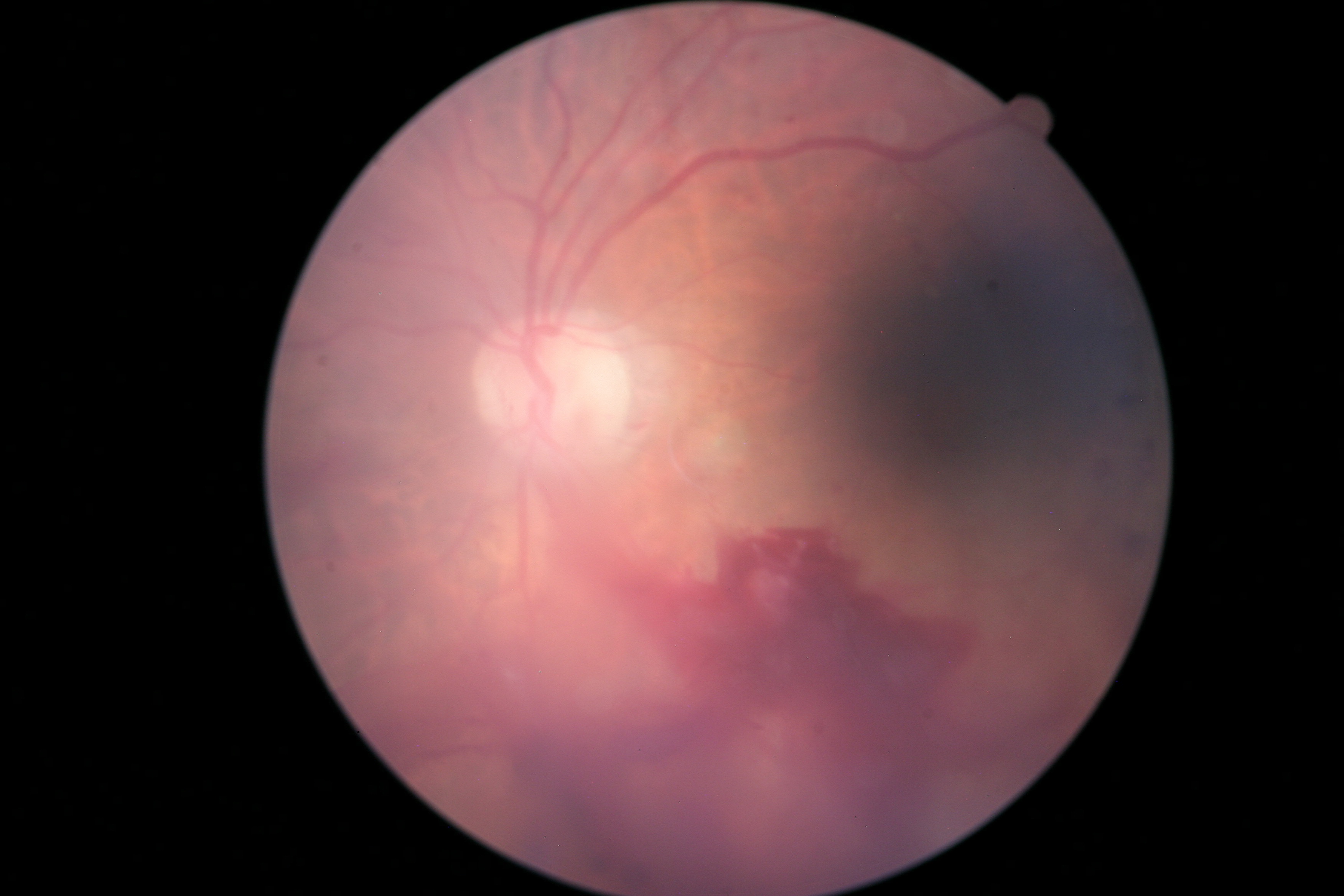 Can Diabetic Retinopathy Improve