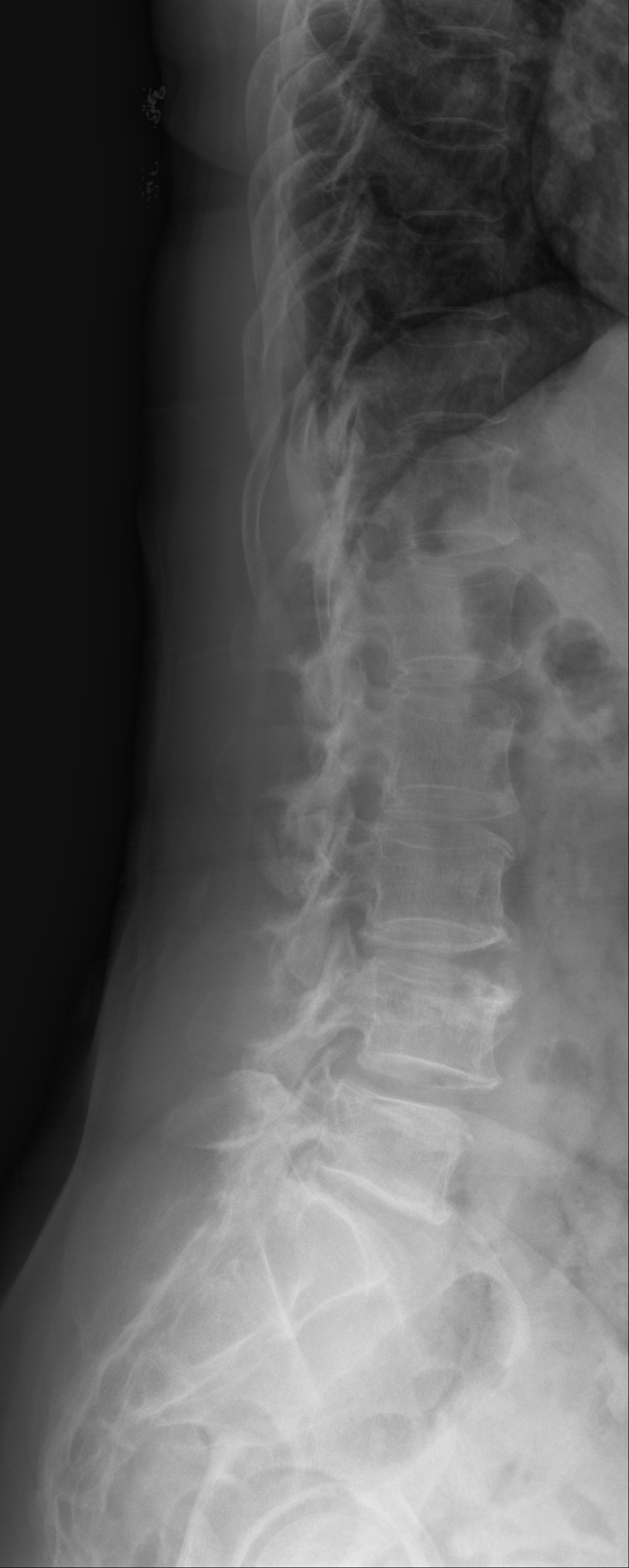 Spondylolisthesis Classification Dataset and PreTrained Model by