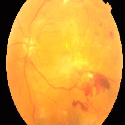 Diabetic Retinopathy Detection Object Detection Dataset By Fayez Diabetic Retinopathy Detection Object Detection Dataset By Fayez