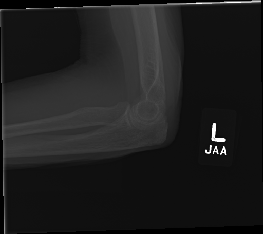 MURA - Fracture Identifier Object Detection Dataset by Adjibola