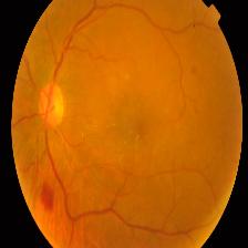 Diabetic Retinopathy Screening AI Classification Dataset And Pre ...