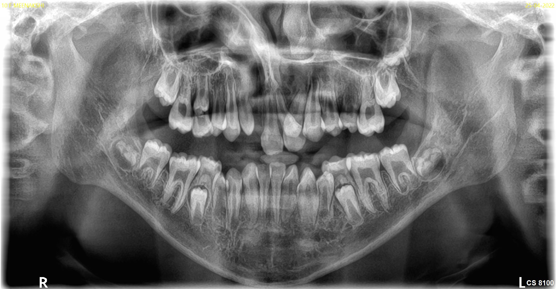 like:teeth-segmentation-18aan/teeth-identification | Roboflow Universe ...