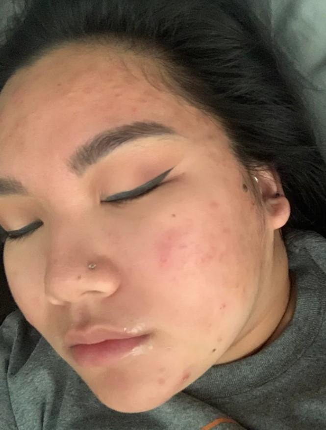 Acne Detection Object Detection Dataset and PreTrained Model by faceinc