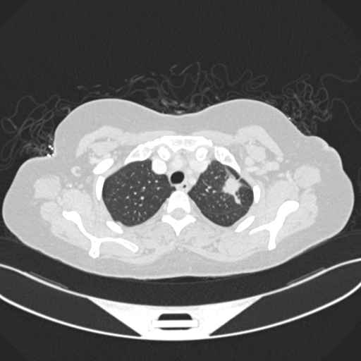 Classification of Lung cancer Classification Dataset and Pre-Trained ...