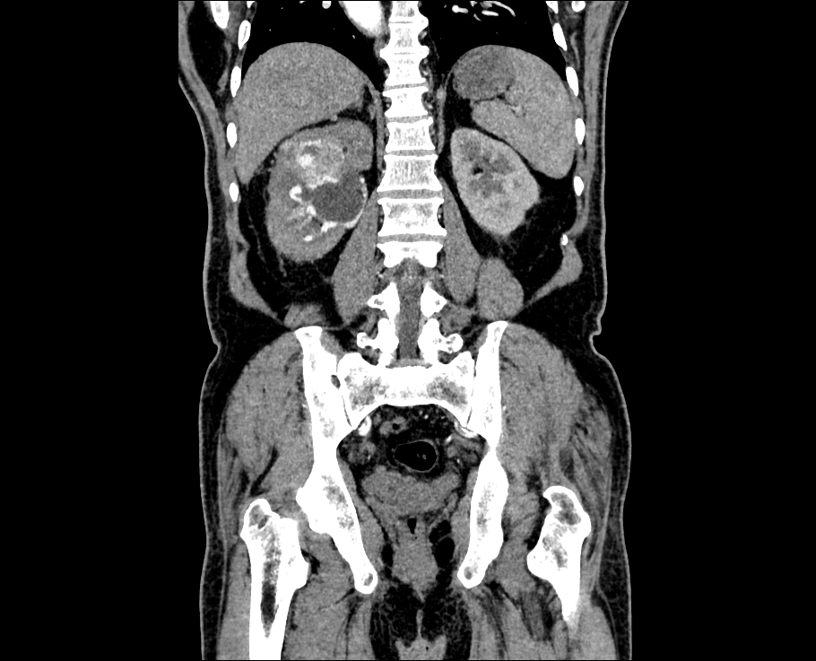 Kidney_Tumor Object Detection Dataset by East Delta University