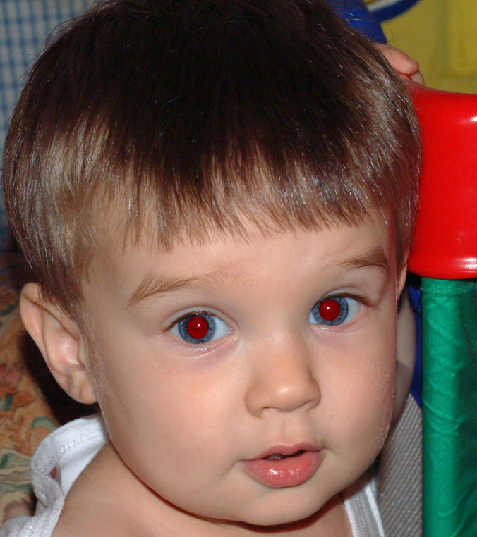 Retinoblastoma Classification Dataset by newworkspacejvb3p