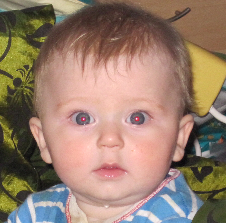 Retinoblastoma Classification Dataset by newworkspacejvb3p