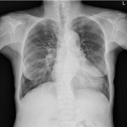 chest xray (chest-xray-rejzg) - Roboflow Universe