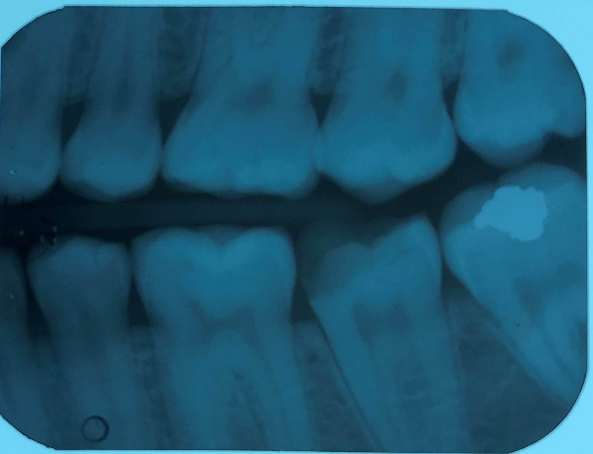 bitewing Object Detection Dataset by deneme