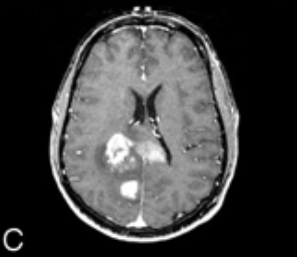 Brain tumour detection - Roboflow Universe