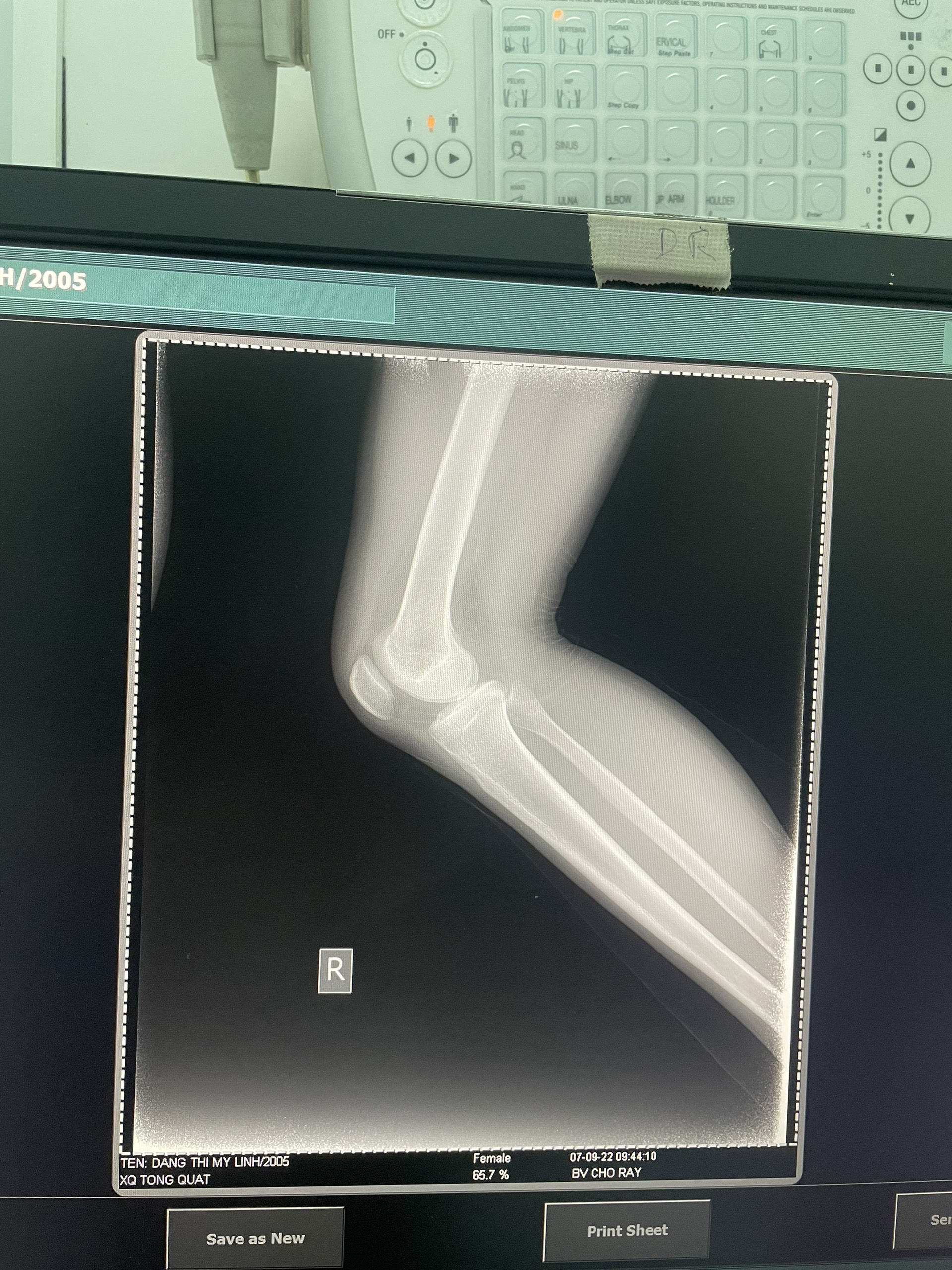 How to Use the knee joint x-ray detection Object Detection API