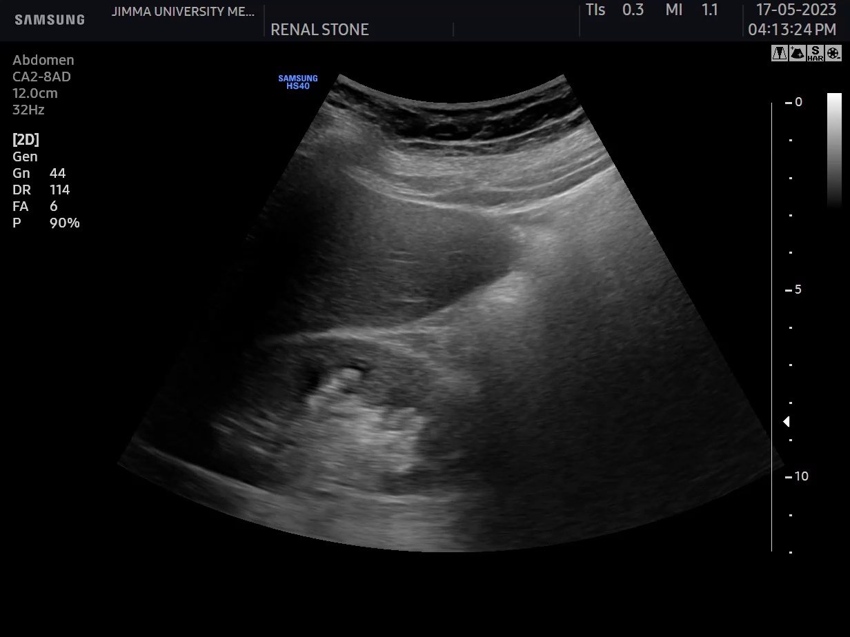 kidney stone labelling with shadow and with out shadow Object Detection