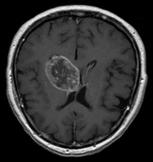 tumor_detection Object Detection Dataset and Pre-Trained Model by ...