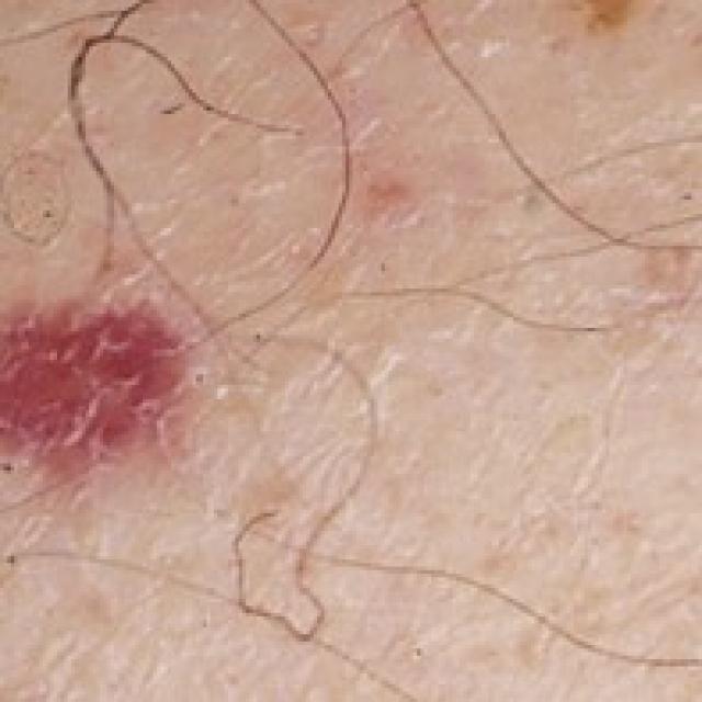 Leukocytoclastic Vasculitis Classification Dataset by Liverify