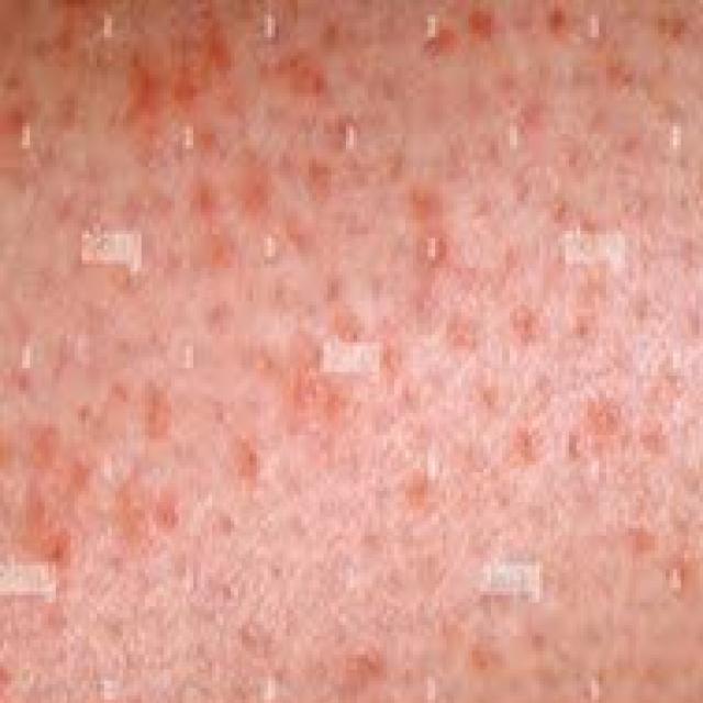 Purpura Classification Dataset by Liverify