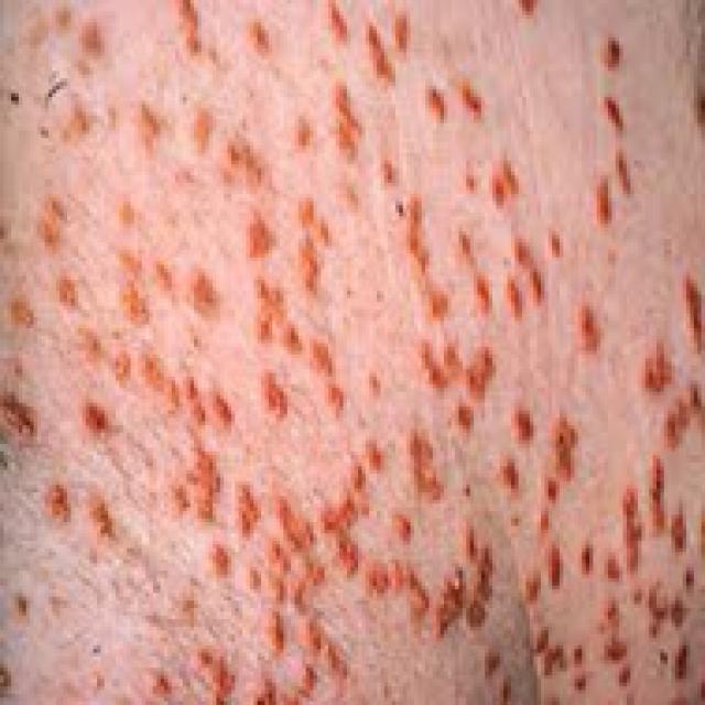 Eruptive Xanthoma Stage 3 Cholestatic Liver Disease Object Detection Dataset by Liverify