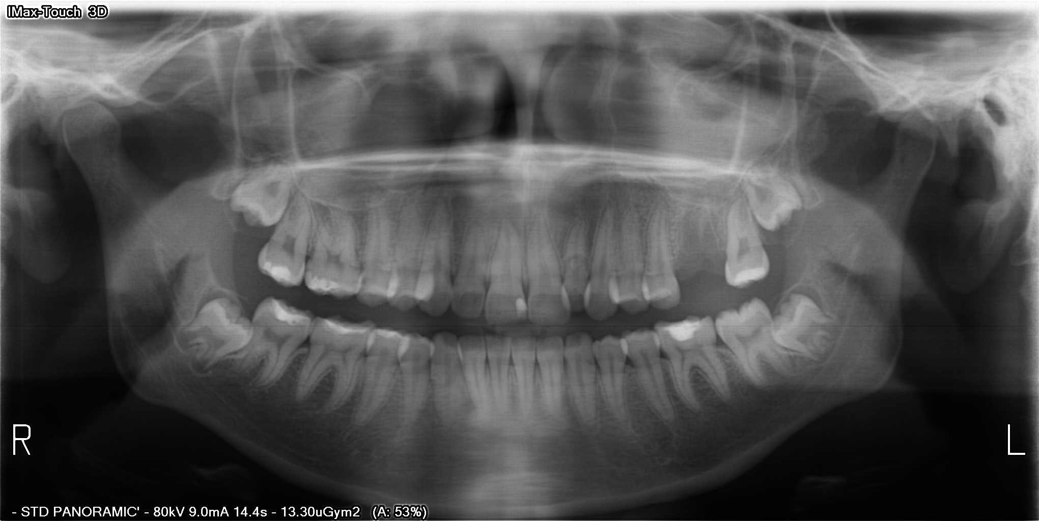 eksikler Object Detection Dataset by Panoramic XRay Images