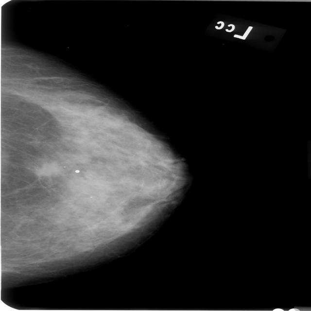 Cancer Cell Detection Object Detection Dataset By Breast Cancer