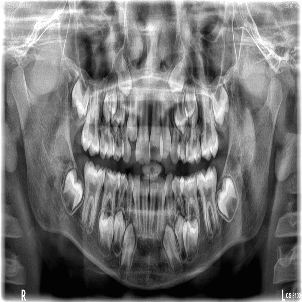 INDIVIDUAL TEETH LABELLING Instance Segmentation Dataset and Pre ...