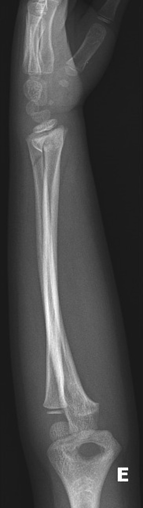 Science Research 2022 Bone Fracture Detection Object Detection Dataset   Original 