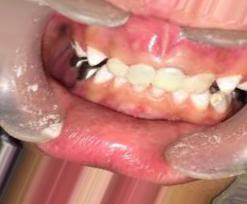 dental cavities Object Detection Dataset and Pre-Trained Model by