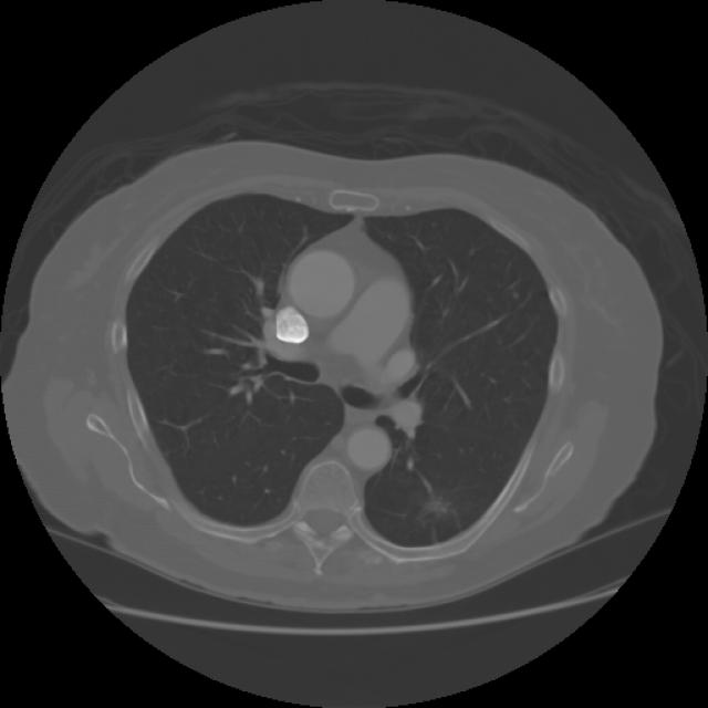 Lung Cancer Nodule Object Detection Dataset By School