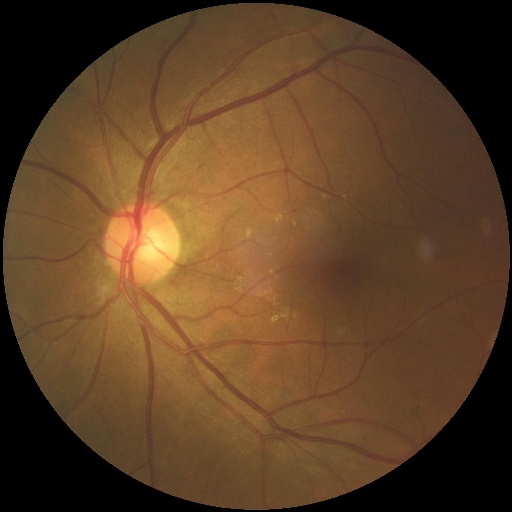 normal Object Detection Dataset by Eye Diseases prediction