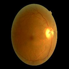 Diabetic Retinopathy Detection Object Detection Dataset (v1 2023 04 26 Diabetic Retinopathy Detection Object Detection Dataset (v1 2023 04 26