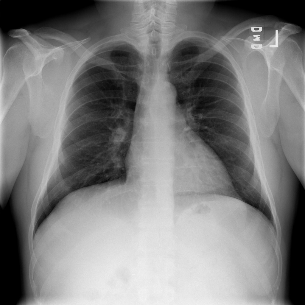 RSNA Pneumonia Detection Dataset Object Detection Dataset by Pavan ...