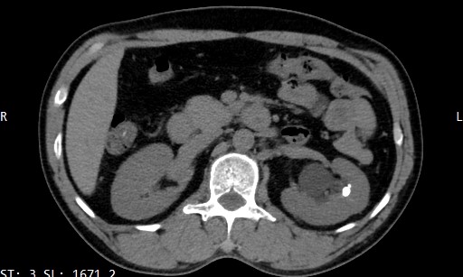 kidney stone 30/11/2565 Object Detection Dataset and Pre-Trained Model ...