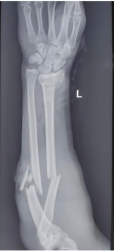 How to Use the long bones x rays Classification API