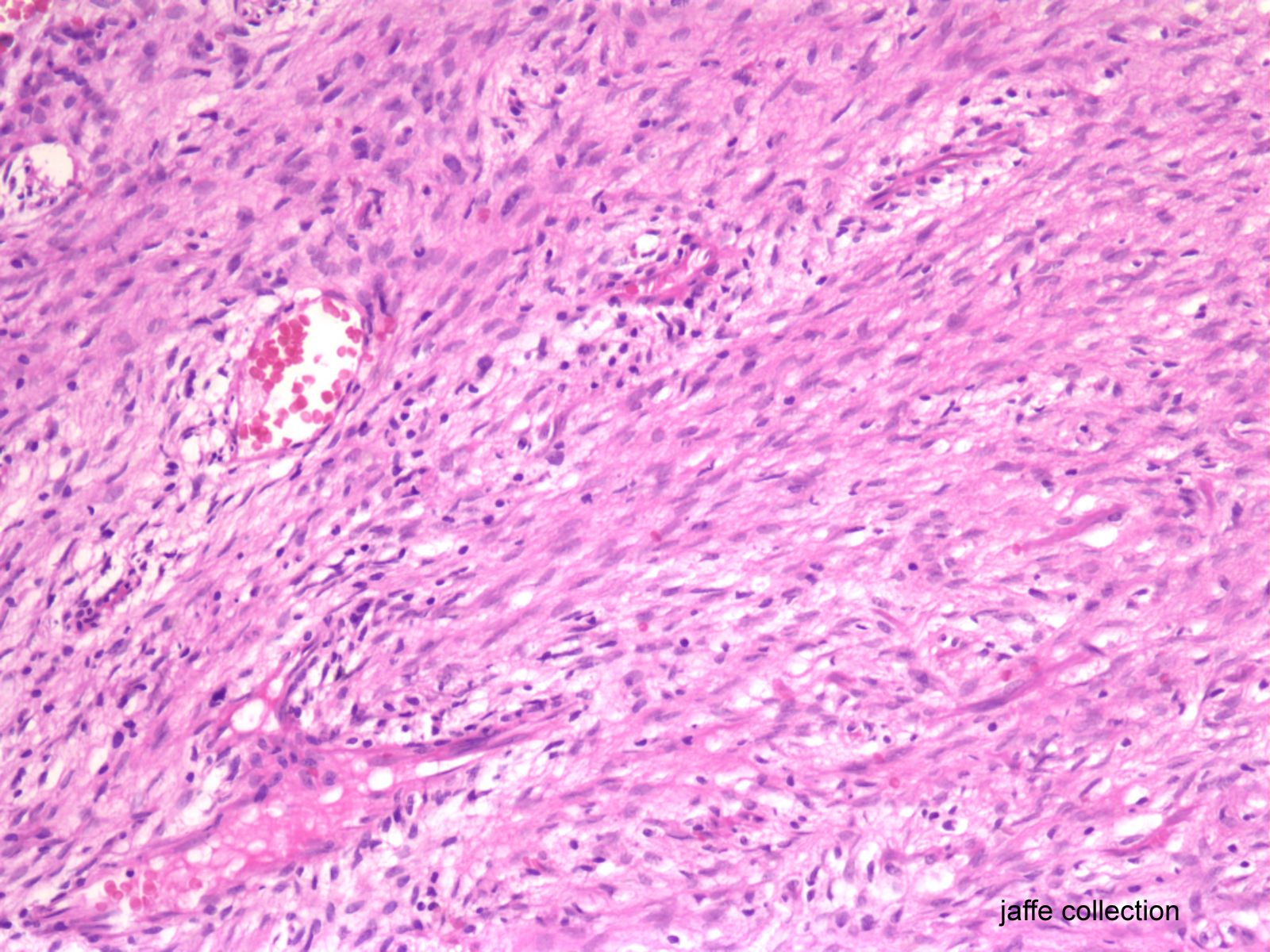 Enchondroma Vs Grade I Chondrosarcoma Classification Dataset By Enchondroma Vs Chondrosarcoma 2875