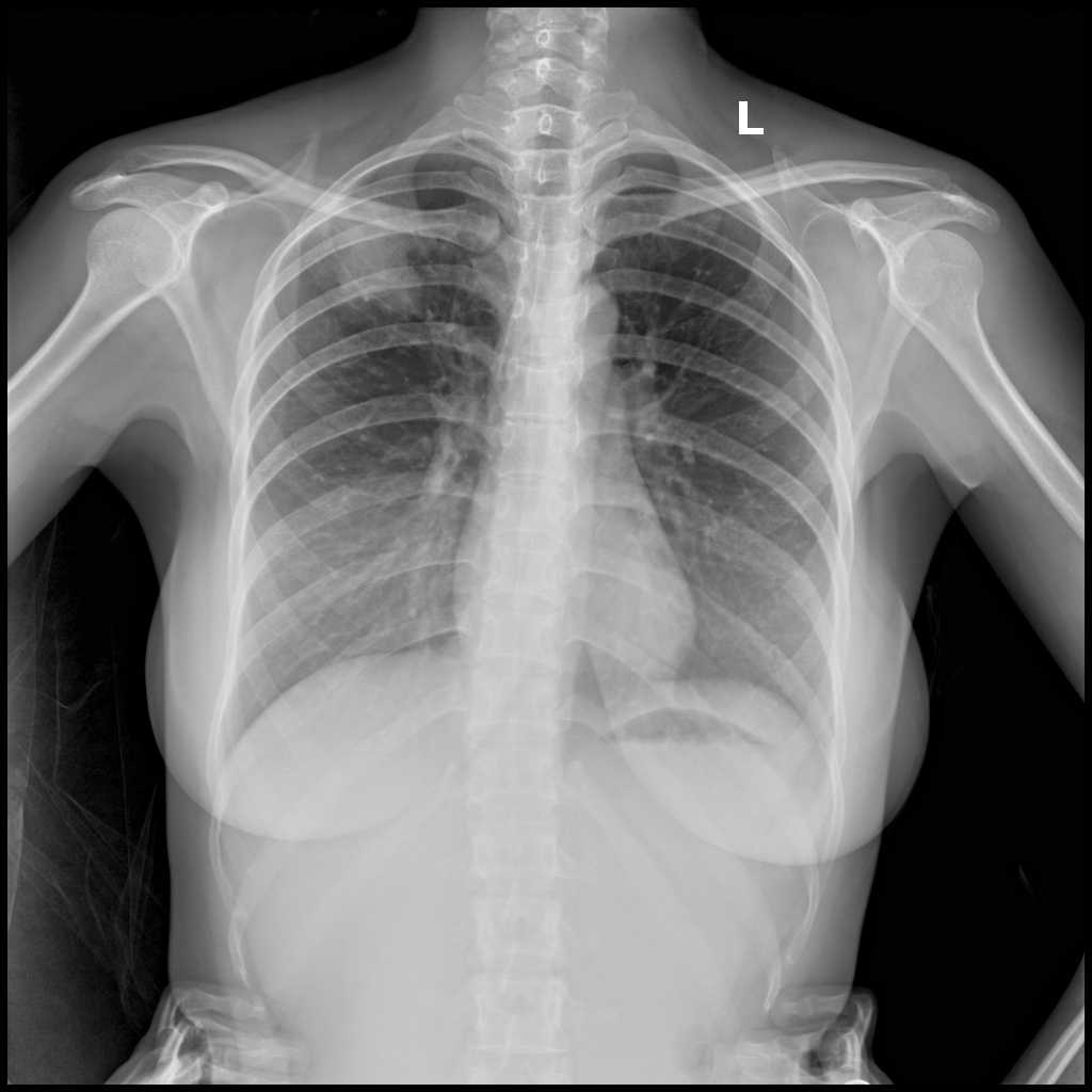 Chest abnormalities Object Detection Dataset by Xray Annotations