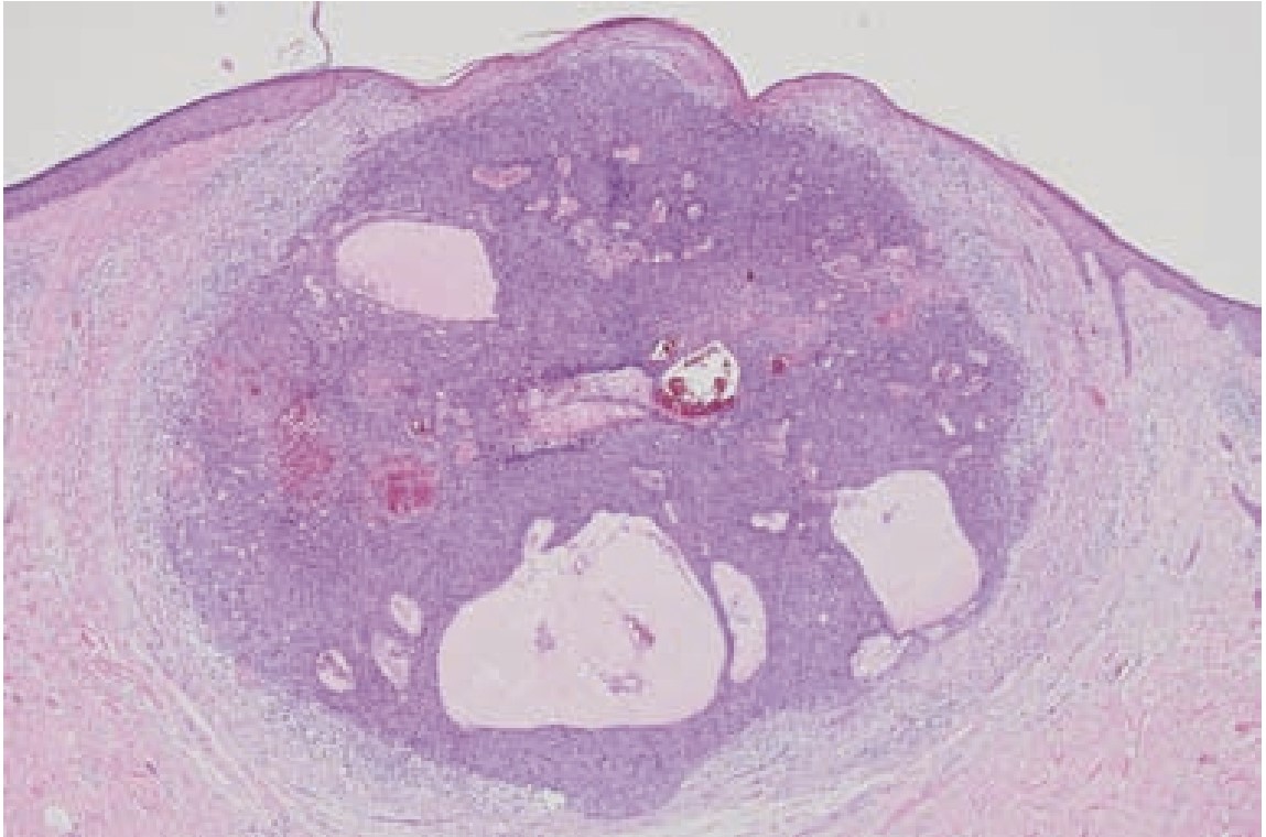 Nodular Basal Cell Carcinoma Ai Detection Classification Dataset By