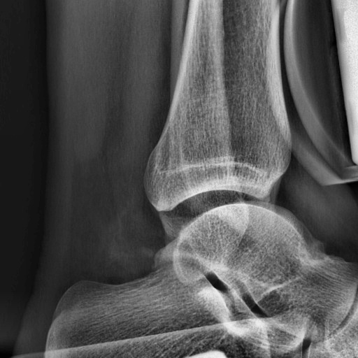 Ankle Sprain Object Detection Dataset by Ankle sprain