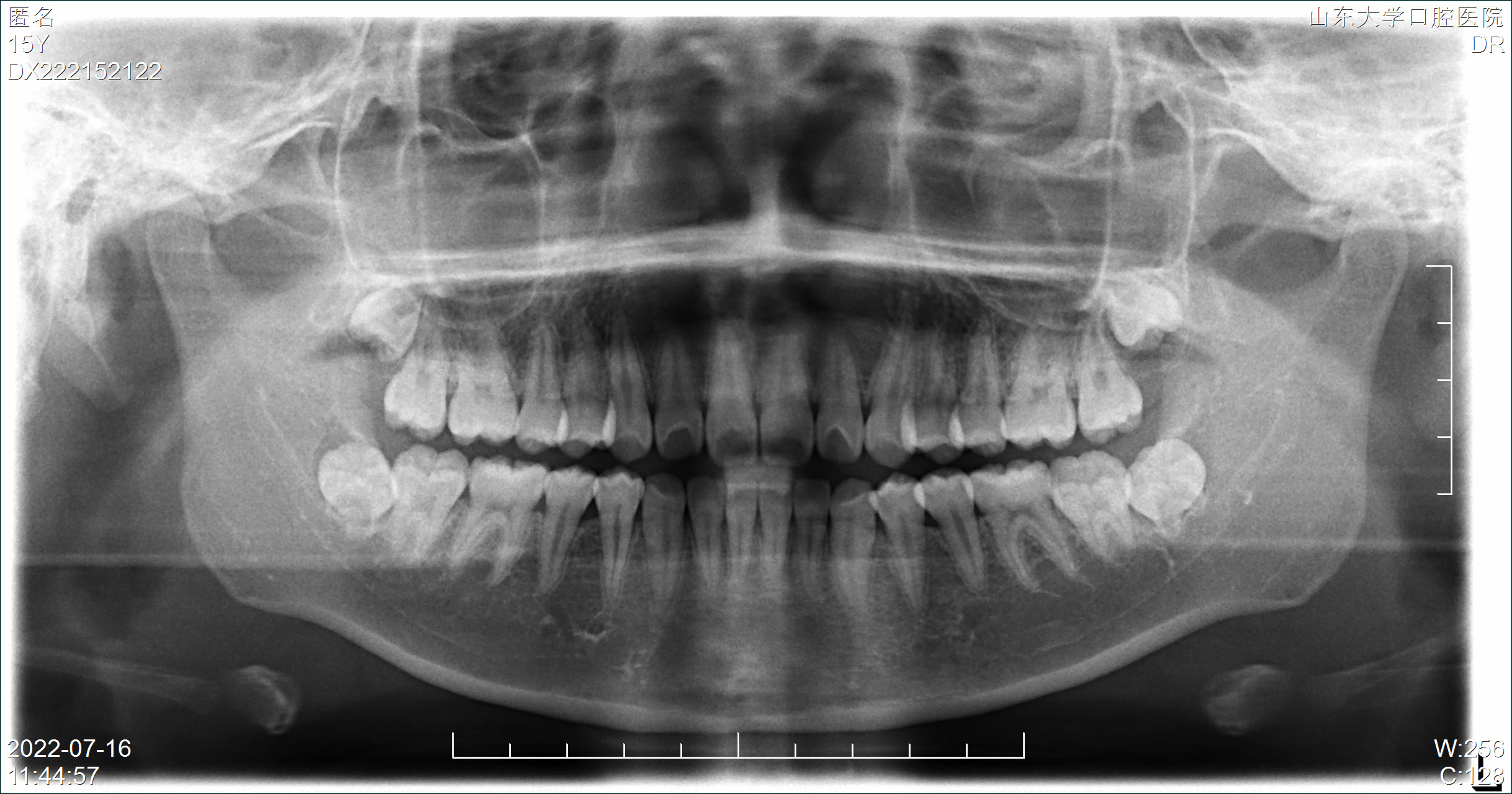 root-canal-detection-object-detection-dataset-by-2023toothdataset